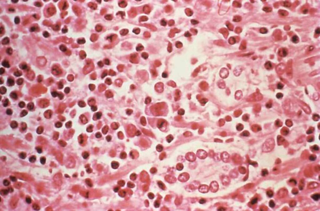 hantavirus