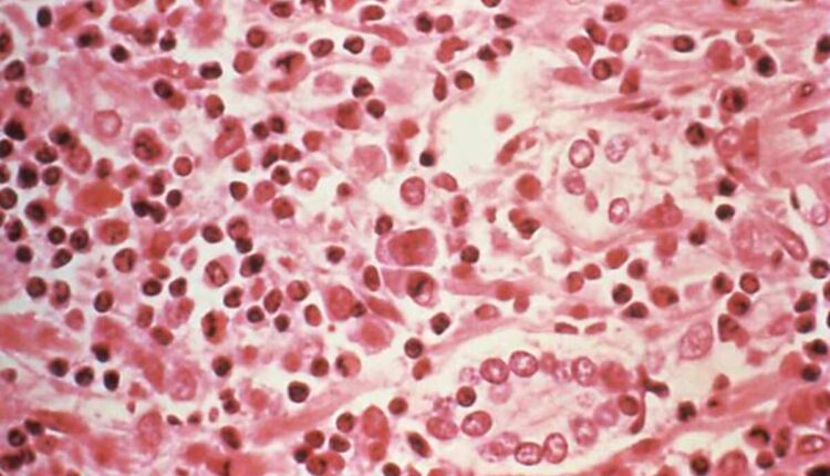 hantavirus