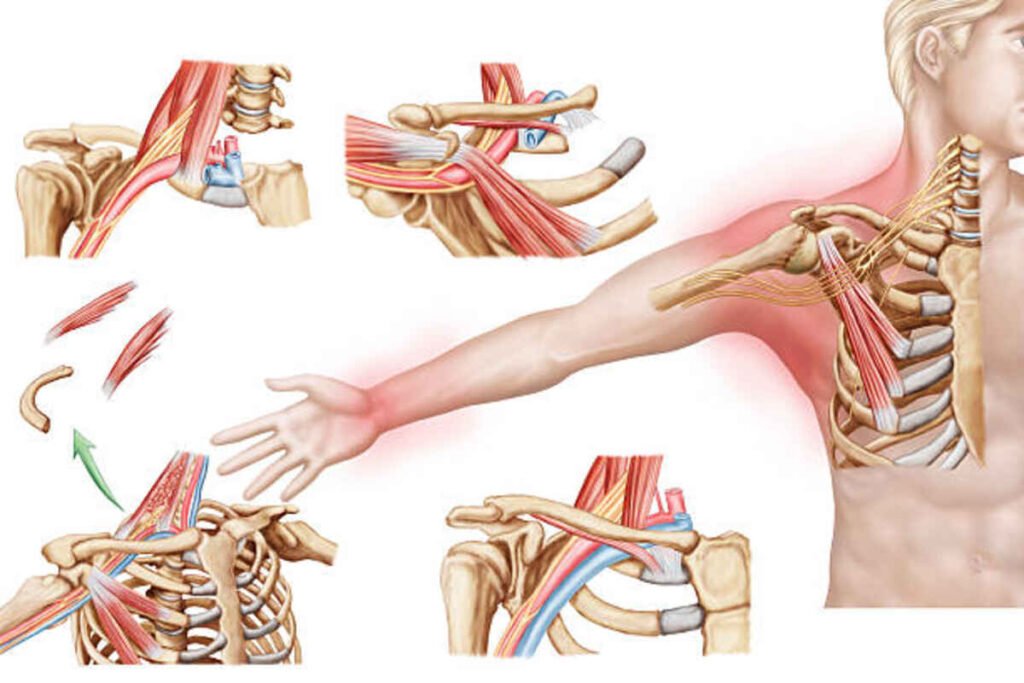thoracic outlet syndrome