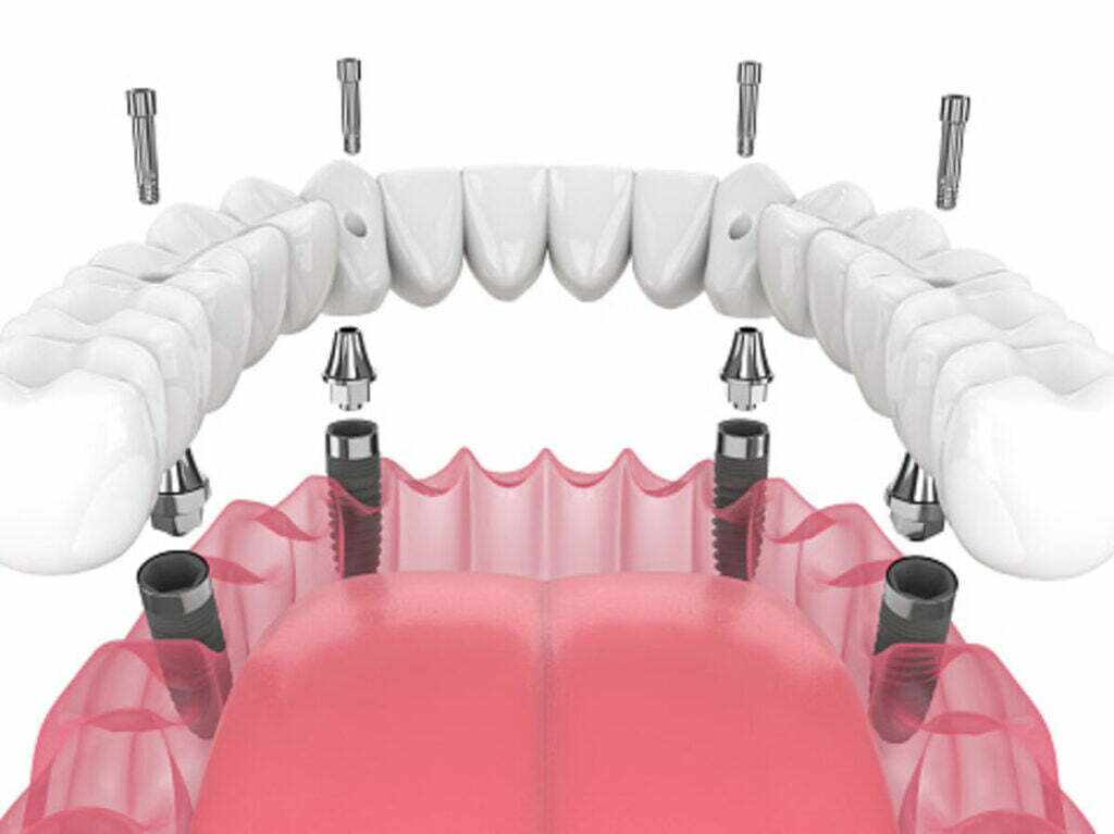 top rated dental implants